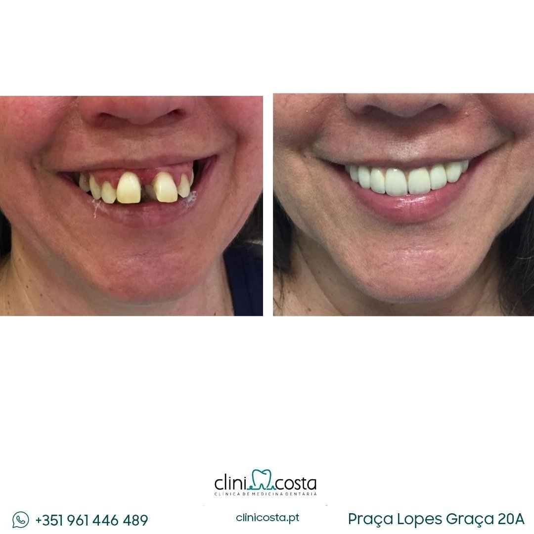 Diagnose immature central incisor with pulp necrosis and symptomatic apical periodontitis,; Follow up 1,5 years with root formation and complete remission of the periapical lesion (1)