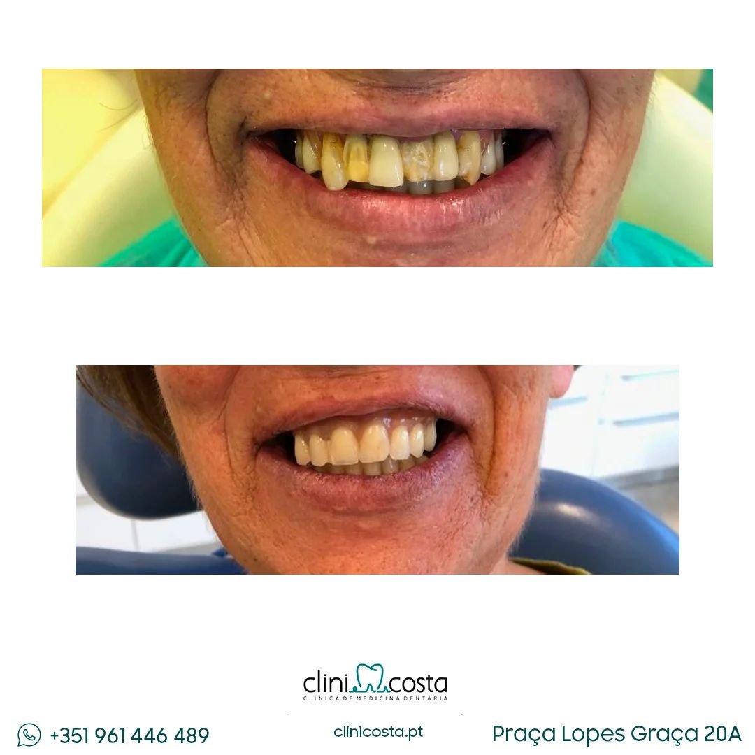 Diagnose immature central incisor with pulp necrosis and symptomatic apical periodontitis,; Follow up 1,5 years with root formation and complete remission of the periapical lesion (2)