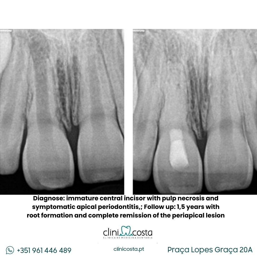 Diagnose immature central incisor with pulp necrosis and symptomatic apical periodontitis,; Follow up 1,5 years with root formation and complete remission of the periapical lesion