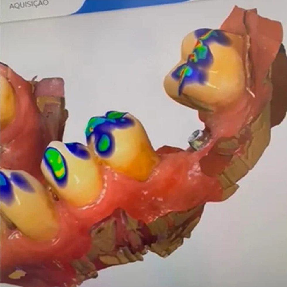 𝐓𝐫𝐚𝐧𝐬𝐟𝐨𝐫𝐦 𝐘𝐨𝐮𝐫 𝐒𝐦𝐢𝐥𝐞 𝐰𝐢𝐭𝐡 𝟑𝐃 𝐓𝐞𝐜𝐡𝐧𝐨𝐥𝐨𝐠𝐲! With the 3D scanner, your dental treatments are faster, more precise, and much more comfortable. Say goodbye to uncomfortable molds – now you can see the future of your smile before even starting! Book your appointment and experience the innovation of digital dentistry. ✨